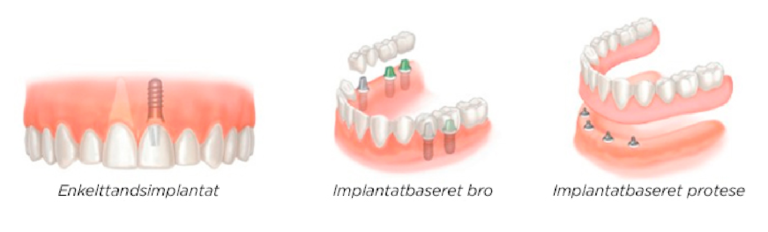 Tandimplantat: Vi Er #1 → Se Priser På Implantat: Spar Op Til 40%